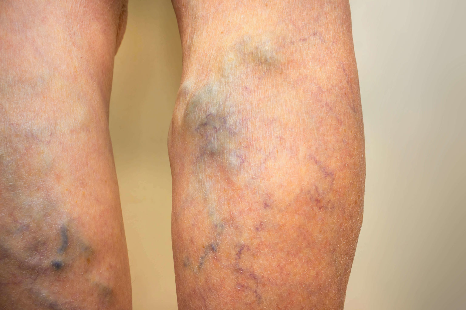 varicose-veins-pulse-cardiovascular-institute